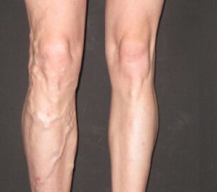 La varicosis progresa rápidamente