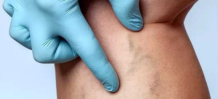 Agrandamiento de las venas de las piernas con venas varicosas. 