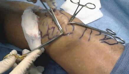 Cirugía para venas varicosas