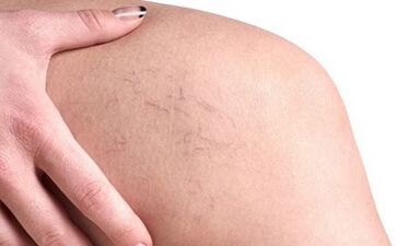 ¿Cómo son las venas varicosas en mujeres reales