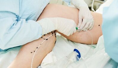 Métodos para el tratamiento de las venas varicosas en los pies en las mujeres
