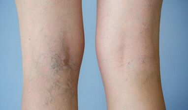Signos a las venas varicosas en los pies en las mujeres