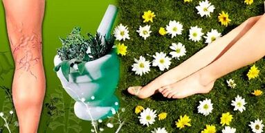 Tratamiento de las varices con remedios caseros.