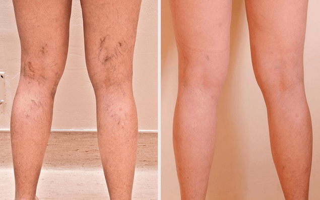 piernas antes y después del tratamiento para las venas varicosas