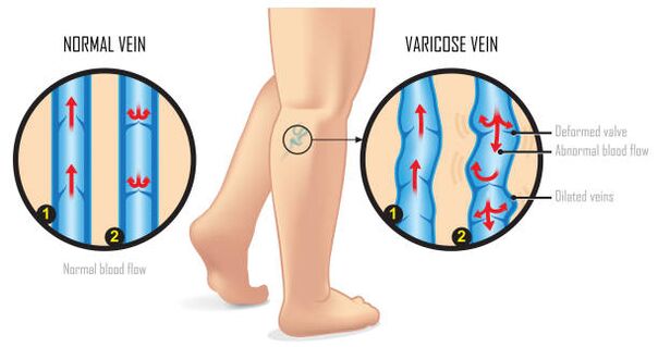 venas varicosas en la parte inferior de la pierna