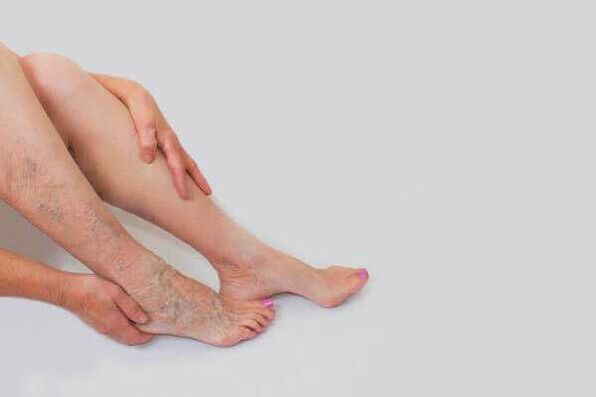 Las venas dilatadas prominentes son un signo de venas varicosas en la parte inferior de las piernas.