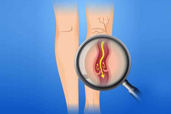 Las válvulas venosas se ven afectadas por las venas varicosas.