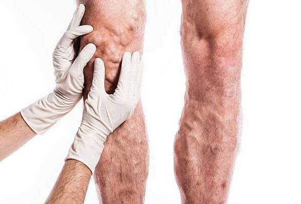 Palpación de varices en las piernas.