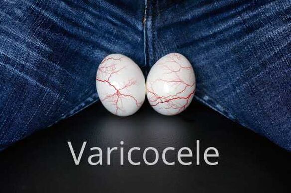 Varicocele agrandamiento de las venas del cordón espermático.